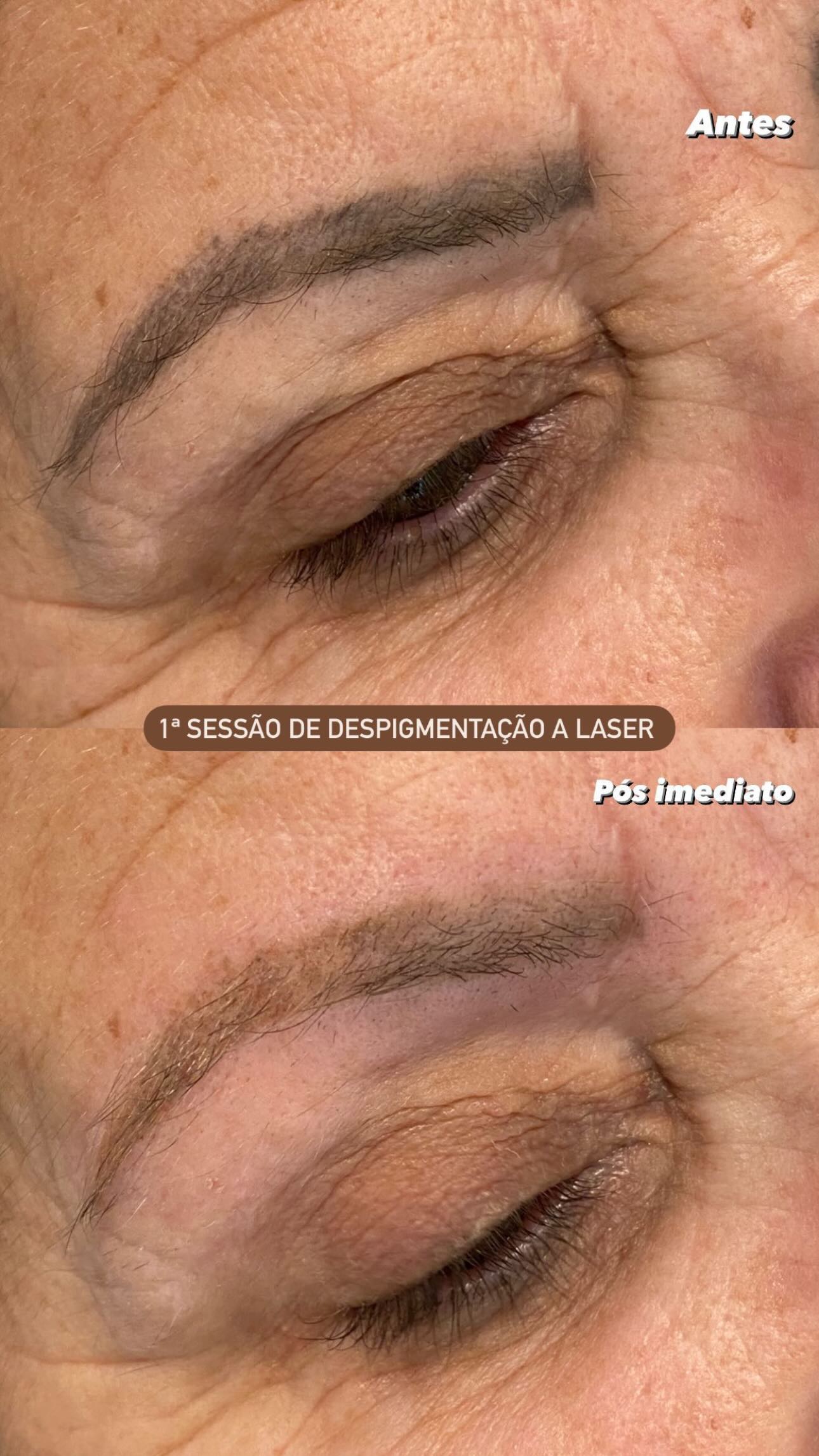 Antes e depois sobrancelhas